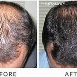 HairMax Laserband 82 -Beurer store 550x300 1