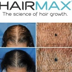Hairmax Laserband 82 ComfortFlex (BlueEdition - Model 2022) 47 Hairmax Laserband 82 ComfortFlex (BlueEdition - Model 2022) -Beurer store 550x515 6