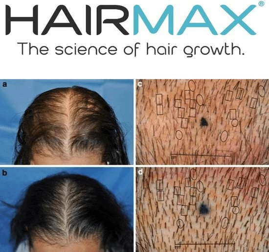 Hairmax Laserband 82 ComfortFlex (BlueEdition - Model 2022) 25 Hairmax Laserband 82 ComfortFlex (BlueEdition - Model 2022) - Afbeelding 23