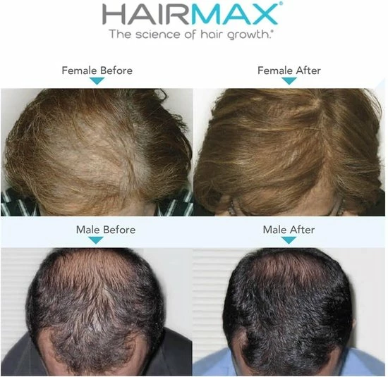 Hairmax Laserband 82 ComfortFlex (BlueEdition - Model 2022) 11 Hairmax Laserband 82 ComfortFlex (BlueEdition - Model 2022) - Afbeelding 9