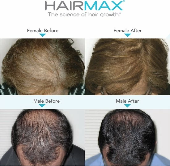 HairMax LaserBand 82 ComfortFlex (Purple Edition - Model 2022) - Afbeelding 4