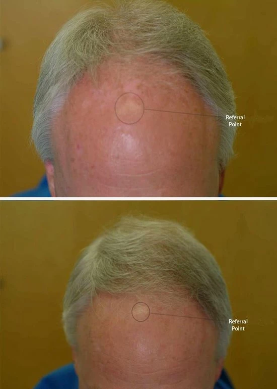 HairMax Laserkam Ultima 12 - Afbeelding 10